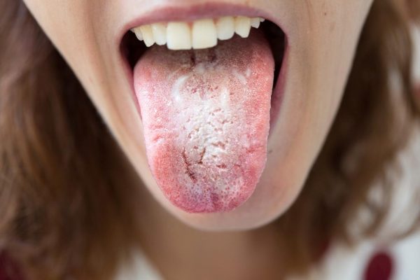 Как узнать, что печень больна: два простых симптома во рту