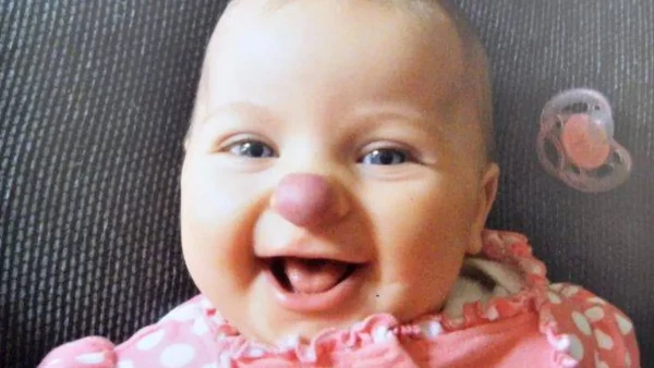 Малышке с клоунским носом сделали пластику, и теперь никто не посмеет над ней потешаться (редкое фото)