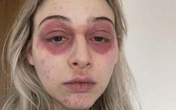 Лицо девушки обезобразилось после популярной косметической процедуры