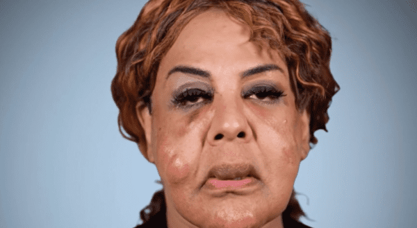 Evil “doctor” pumped her face full of cement – this is what she looks like 14 years later