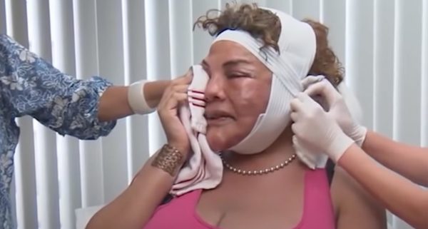 Evil “doctor” pumped her face full of cement – this is what she looks like 14 years later