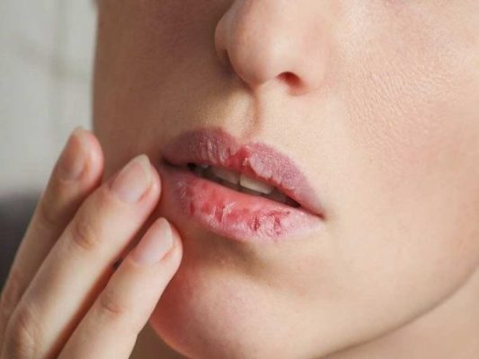 Проблемы со здоровьем можно определить по губам