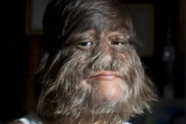 The “World’s Hairiest Girl” has revealed her new look. She has now grown her hair completely and is in a loving relationship