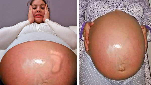 For three and a half years, she was certain she was carrying a child—but after surgery, doctors discovered something that stunned the entire ward